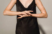 Cropped view of woman with vitiligo touching hands on grey background  Poster #624428634