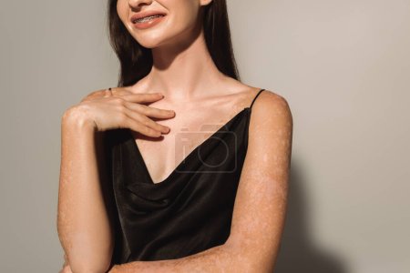 Vue recadrée de la femme souriante avec vitiligo toucher la poitrine sur fond gris 
