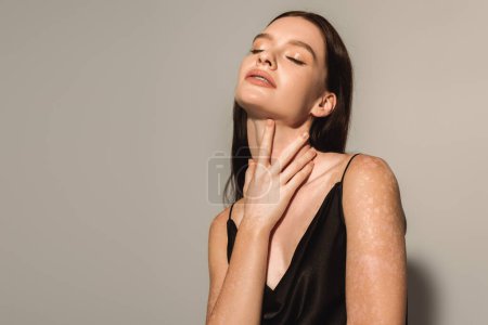 Brunette woman with vitiligo in black satin dress touching neck on grey background 