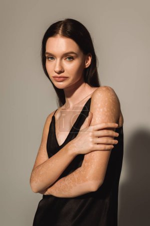 Porträt eines brünetten Modells mit Vitiligo im Satinkleid mit Blick auf die Kamera auf grauem Hintergrund 