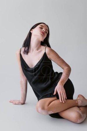 Brunette woman with vitiligo posing in satin dress while sitting on grey background 