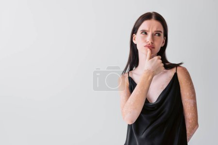 Pensive woman with vitiligo touching lip isolated on grey 