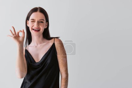 Lächelnde Frau mit Vitiligo zeigt ok Geste und zwinkert in die Kamera isoliert auf grau 