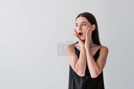 Shocked woman with vitiligo touching cheeks and looking away isolated on grey 