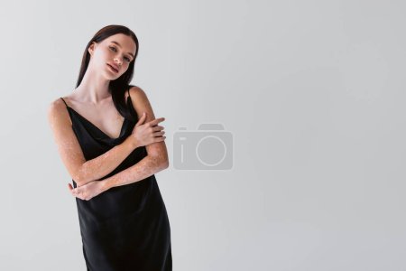 Photo for Pretty woman with vitiligo in satin dress touching arms and looking at camera isolated on grey - Royalty Free Image