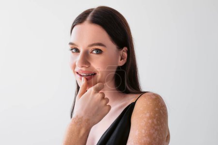 Portrait de jolie femme avec lèvres vitiligo touchantes et souriant à la caméra isolé sur gris 