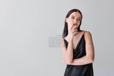 Pretty model with vitiligo touching lips and looking away isolated on grey 