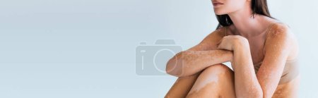 vista recortada del modelo con vitiligo sentado aislado en gris, pancarta