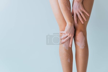 vista recortada del modelo con condición crónica de la piel vitiligo posando aislado en gris 