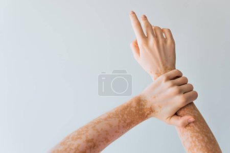 vista recortada de la mujer con condición de la piel crónica vitiligo en las manos aisladas en gris 