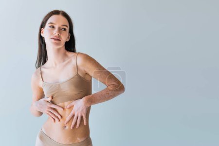 brunette woman with vitiligo chronical skin condition touching belly isolated on grey 