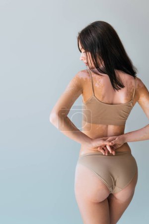 back view of young woman with vitiligo standing in underwear isolated on grey