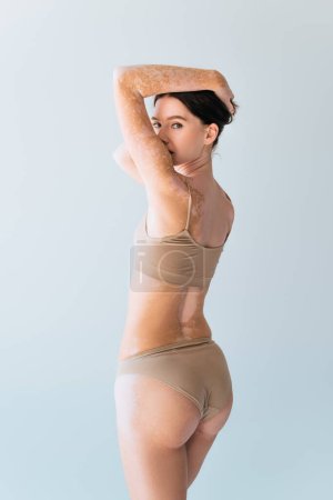young woman with vitiligo standing in beige lingerie and looking at camera isolated on grey