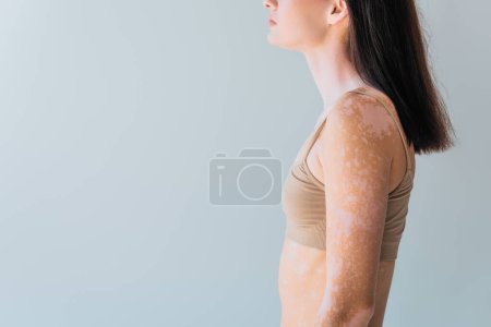 Foto de Recortado vista de morena joven con vitiligo de pie aislado en gris - Imagen libre de derechos