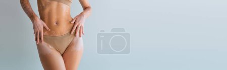 partial view of young woman with vitiligo standing in underwear isolated on grey, banner 