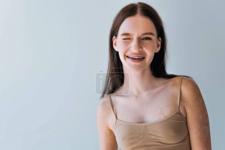 glückliche junge Frau mit Vitiligo und Zahnspange zwinkert vereinzelt auf grau