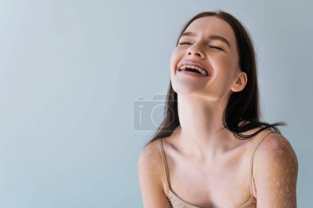 Photo for Happy young woman with vitiligo and braces laughing isolated on grey - Royalty Free Image