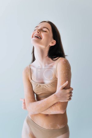 cheerful young woman with vitiligo and braces smiling isolated on grey 