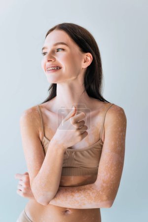 Foto de Mujer joven positiva con vitiligo y frenos sonrientes aislados en gris - Imagen libre de derechos