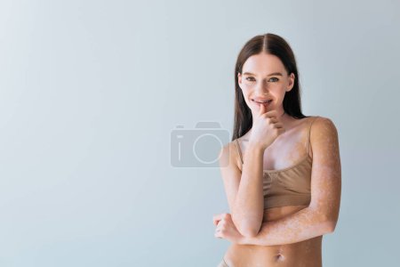 joyful young woman with vitiligo and braces smiling isolated on grey