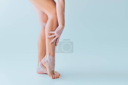 Teilbild einer jungen Frau mit Vitiligo und nackten Füßen auf grauem Hintergrund