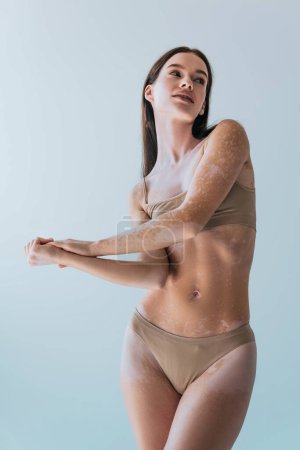 brunette young woman with vitiligo looking away while posing isolated on grey