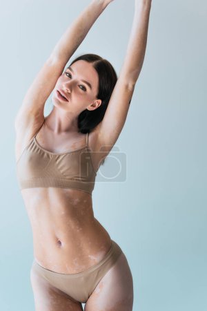 brunette young woman with vitiligo looking at camera while posing with raised hands isolated on grey