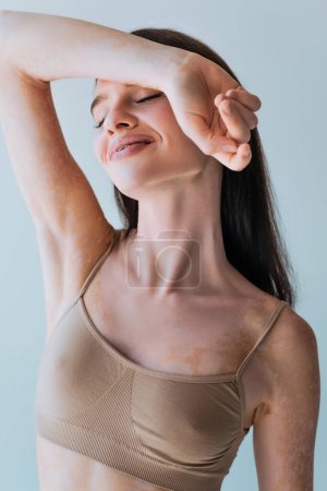 retrato de mujer joven y contenta con vitiligo y ojos cerrados posando aislados sobre gris