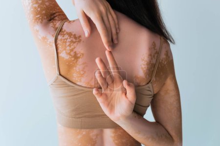 vista posterior de mujer morena con vitiligo tocando los dedos detrás de la espalda aislado en gris 