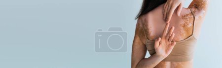 Photo for Back view of brunette woman with vitiligo touching fingers behind back isolated on grey - Royalty Free Image