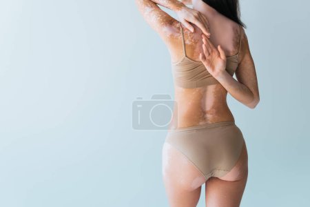 back view of young woman with vitiligo touching fingers behind back while standing isolated on grey 