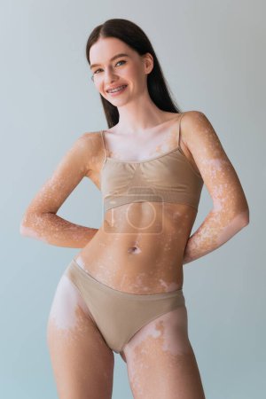 happy young woman with vitiligo and braces smiling and standing isolated on grey