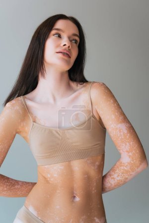 young woman with vitiligo standing in beige top bra and looking away isolated on grey