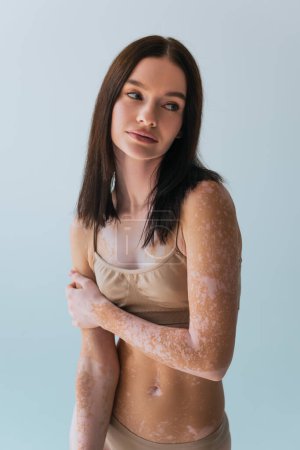 young model with vitiligo standing in beige top bra and looking away isolated on grey