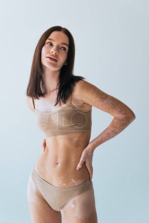 brunette model with vitiligo standing with hand on hip isolated on grey