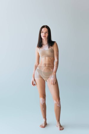 full length of brunette young woman with vitiligo posing in beige lingerie on grey