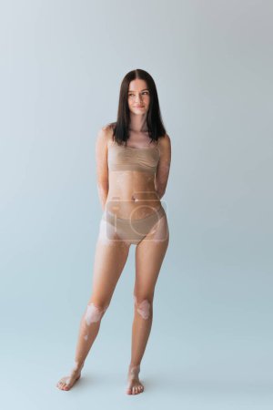 full length of smiling young woman with vitiligo posing in beige lingerie on grey
