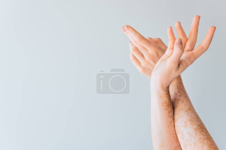 Foto de Vista recortada de manos femeninas jóvenes con vitiligo aislado en gris - Imagen libre de derechos
