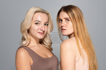 Téléchargez les photos : Jeunes femmes avec des taches de rousseur et l'acné regardant la caméra isolée sur gris - en image libre de droit