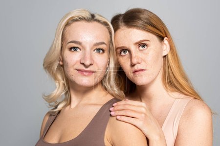 Freckled woman looking at camera near smiling friend with acne isolated on grey 