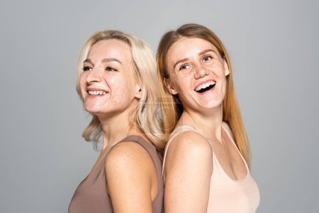 Fröhliche Frauen mit Hautproblemen, die Rücken an Rücken isoliert auf grau stehen 