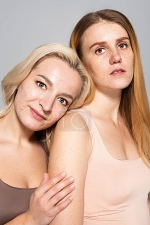 Portrait of women with skin issues standing and looking at camera isolated on grey 