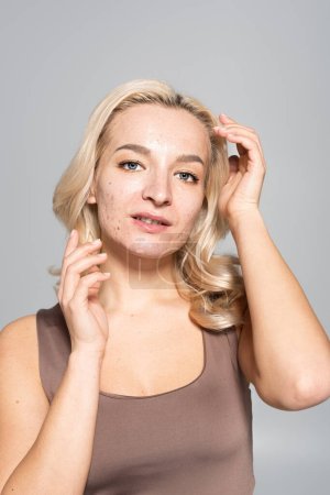 Porträt einer blonden Frau mit Hautproblemen, die isoliert auf grau in die Kamera blickt 