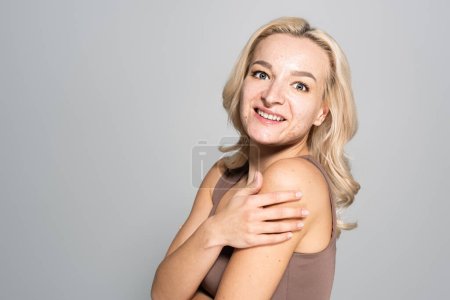 Carefree woman with acne on skin touching shoulder isolated on grey 