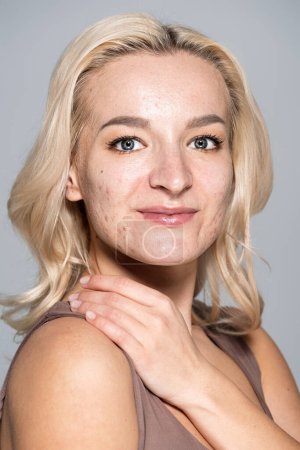 Porträt einer lächelnden Frau mit Akne im Gesicht, die die Schulter berührt, isoliert auf grau 
