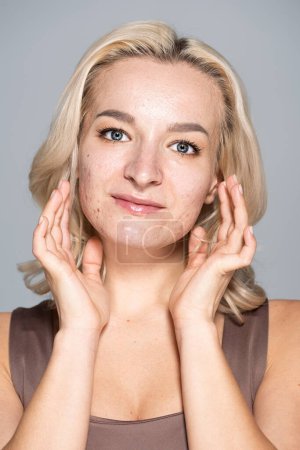 Hübsche blonde Frau mit Hautproblem und Akne posiert isoliert auf grau 