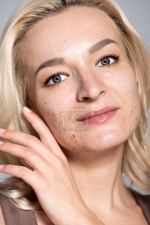 Close up view of blonde woman with acne on skin isolated on grey 