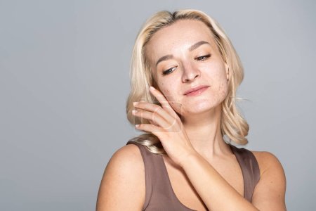 Pretty blonde woman with problem skin touching cheek isolated on grey 