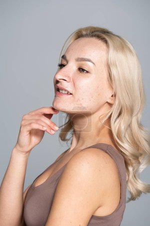 smiling woman with acne on face touching chin and looking away isolated on grey 