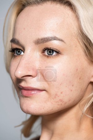 Téléchargez les photos : Vue rapprochée de la femme avec acné sur la peau regardant loin isolé sur gris - en image libre de droit